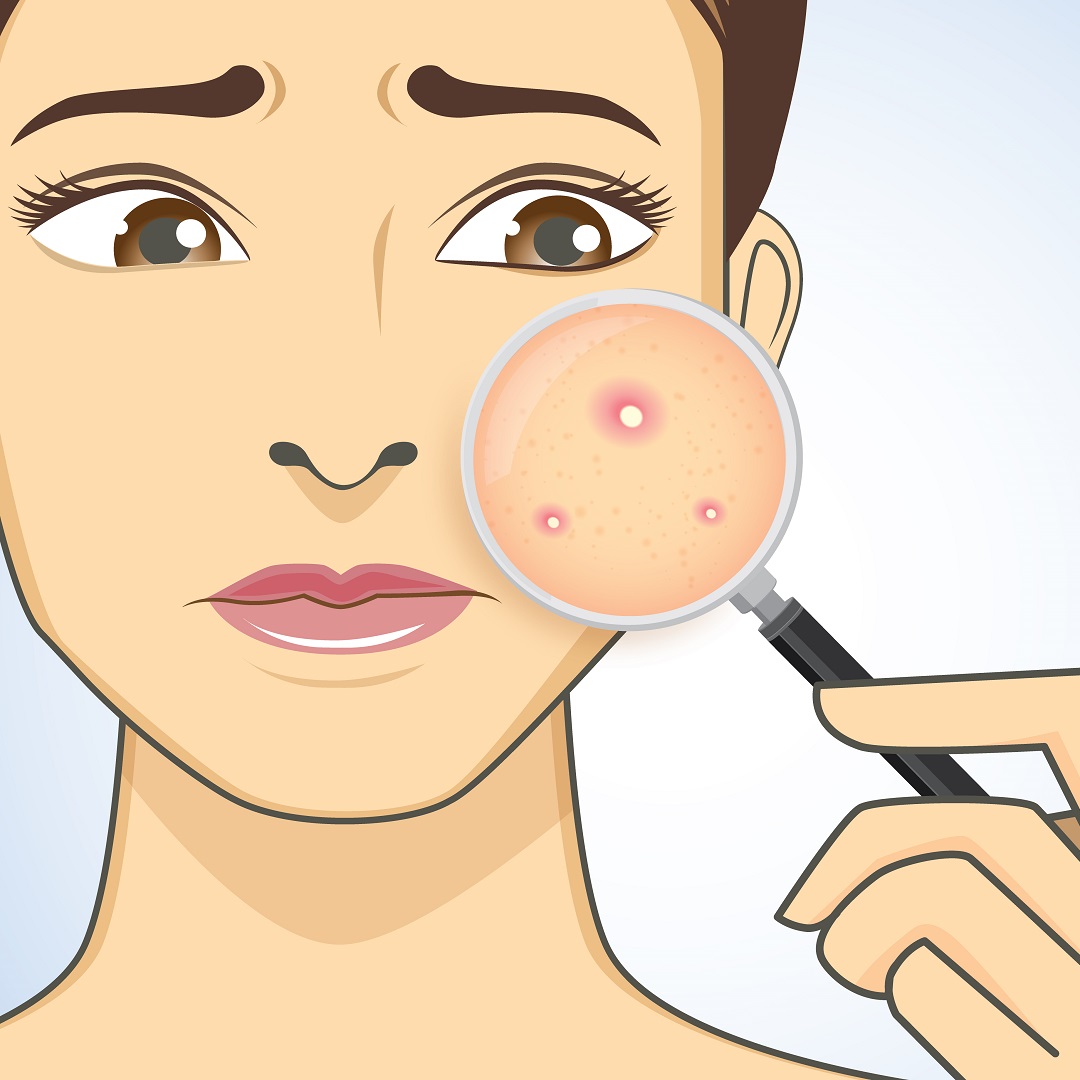 Understanding the Causes of Acne and Skin Pigmentation Spots