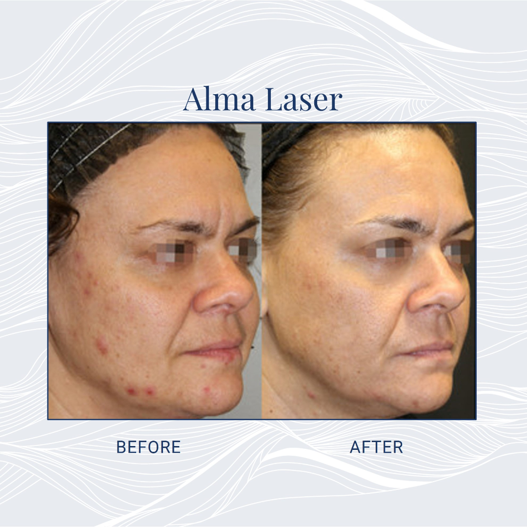 Radiant Facial Rejuvenation with Cutting-Edge Technology » Symbios