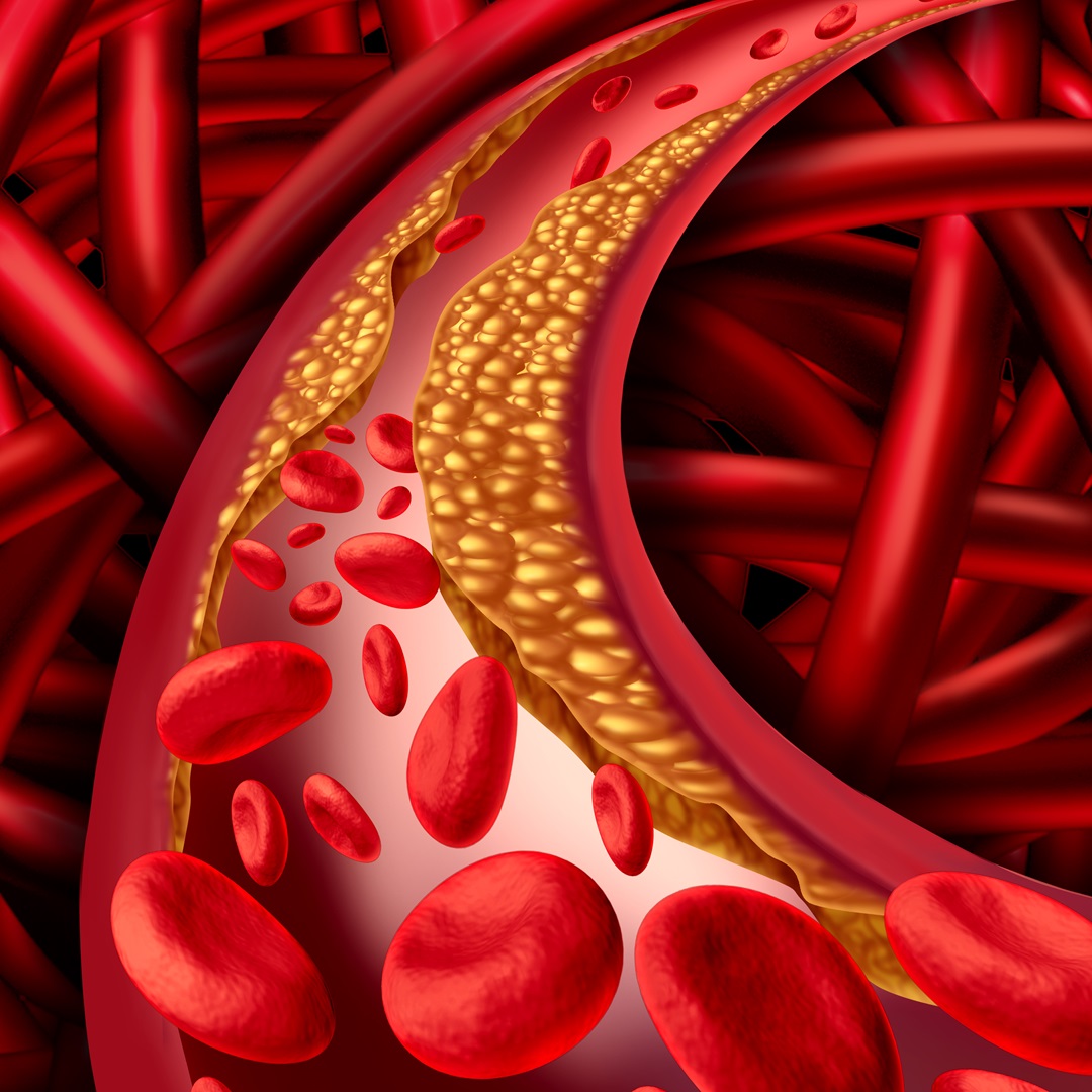 Rethinking LDL Cholesterol: Insights from Recent Research